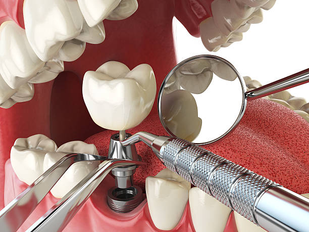 Best Emergency Tooth Extraction in Shiner, TX